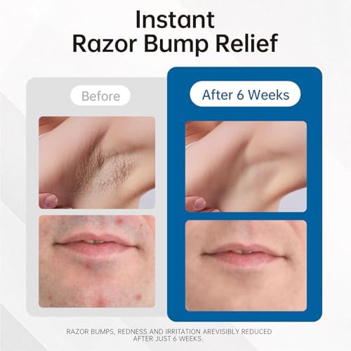 Razor Bumps Ingrown Hair Treatment: 3.38fl.oz Smoothing Solution for Body, Beard & Bikini Area Post Waxing After Shaving Serum for Ingrown Hair & Razor Burn - Women & Men