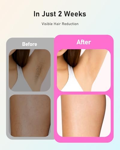 LYSMOSKI Laser Hair Removal for Women and Men, At-Home IPL Hair Removal Device with 5.2 cm² Treatment Window, Nearly Painless, Visible Results in 2 Weeks, Full Body Treatment in 8 Minutes,Pink