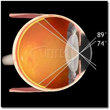 Volk Optical 90D Indirect Ophthalmic Slit Lamp Lens - Blue
