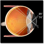 Volk Optical 90D Indirect Ophthalmic Slit Lamp Lens - Blue