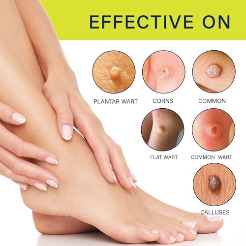 Fast-Acting Wart Remover Freeze Off: Salicylic Acid Maximum Strength Wart Removal Freeze Away for Men and Women - Plantar Wart Genital Wart Corns Calluses 1 oz