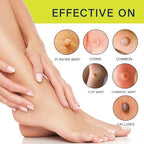 Fast-Acting Wart Remover Freeze Off: Salicylic Acid Maximum Strength Wart Removal Freeze Away for Men and Women - Plantar Wart Genital Wart Corns Calluses 1 oz