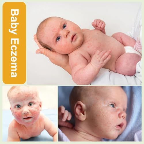 Heat Rash Care Cream for Babies | Prevents Prickly Heat, Sweat Rashes, Eczema & Skin Inflammation | Alleviating Discomfort for Babies Skin | 100ml/3.38oz (100ml/1pcs)