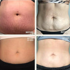 Dermaclara Silicone Patch Stretch Mark Kit - Pregnancy Stretch Mark Prevention, C Section Cover Up Belly Scar, Maternity Skincare, Silicone Gel Sheet, Reusable up to 30 Times - 2 Patches & 1 Cleanser