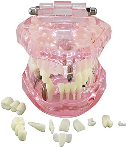 Teeth Model Teeth Typodonts Dental Implant Study Analysis Demonstration Teeth Model #2001 with Restoration Pink