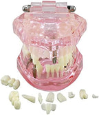 Teeth Model Teeth Typodonts Dental Implant Study Analysis Demonstration Teeth Model #2001 with Restoration Pink