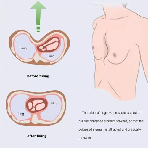 Pectus Excavatum Vacuum Bell - Pectus Excavatum Orthosis Brace,Pectus Excavatum Brace for Adults and Child,Washable,Physical Correction of Pectus Excavatum(S-S)