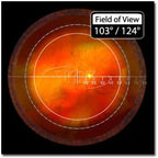 Volk Optical Digital Wide-Field Indirect Ophthalmic Slit Lamp Lens - Blue