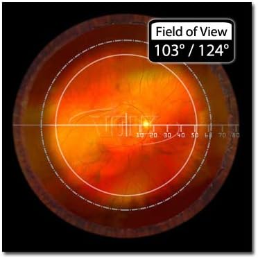 Volk Optical Digital Wide-Field Indirect Ophthalmic Slit Lamp Lens - Blue
