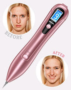 Wart and Skin Tag Remover Pen, Advanced at-Home Removal Kit Beauty Tool, Model CTS-15