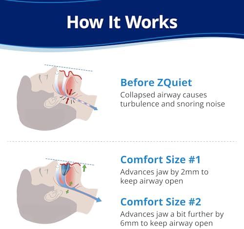 ZQuiet, Anti-Snoring Mouthpiece, Starter Pack with 2 Sizes, Living Hinge & Open Front Design for Comfort & Easy Breathing, Blue