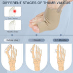 KTSAY 2PCS Bunion Corrector for Women & Men, Big Toe Straightener with Splint & Pads, Comfortable & Breathable for Day/Night Support, Hallux Valgus Pain Relief Non-Slip Socks (1, Beige)