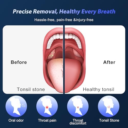 Upgraded Electric Tonsil Stone Remover – High-Precision & Painless Cleaning, Food-Grade Material, 6 Suction Levels | Tonsil Stone Removal Kit with LED Light, Oral Protection & 11 Attachments