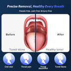 Upgraded Electric Tonsil Stone Remover – High-Precision & Painless Cleaning, Food-Grade Material, 6 Suction Levels | Tonsil Stone Removal Kit with LED Light, Oral Protection & 11 Attachments