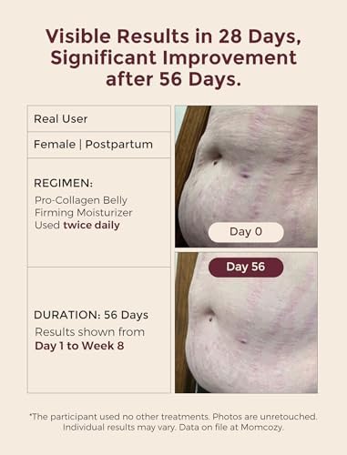 Momcozy Stretch Mark Cream for Pregnancy & Postpartum, Pro-Collagen Belly Firming Moisturizer, Facial-Grade Peptides & Oil-in-Cream, 5.29 oz (150g)