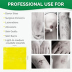 Xeroform Petrolatum Dressing 2inx2in 25 Individual Pack Wound Dressing, Non-Adherent Gauze Pads for Wounds, Partial Thickness Burns, Lacerations, Skin Grafts, Recipient Sites, Sutured Wounds