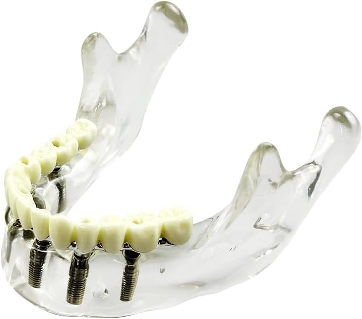 Dental Implant Practice Model, YOUYA DENTAL Maxillary Sinus Implant Model Dental Mandibular Sinus with Soft Gums for Dentist Student Studying Teaching Training Teaching Demonstration Clinic Model