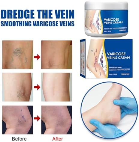 Varicose Veins Cream for Legs, Skin Cream for Legs, Moisturizing Leg Creams 50g/1.76fl.oz (2PCS)