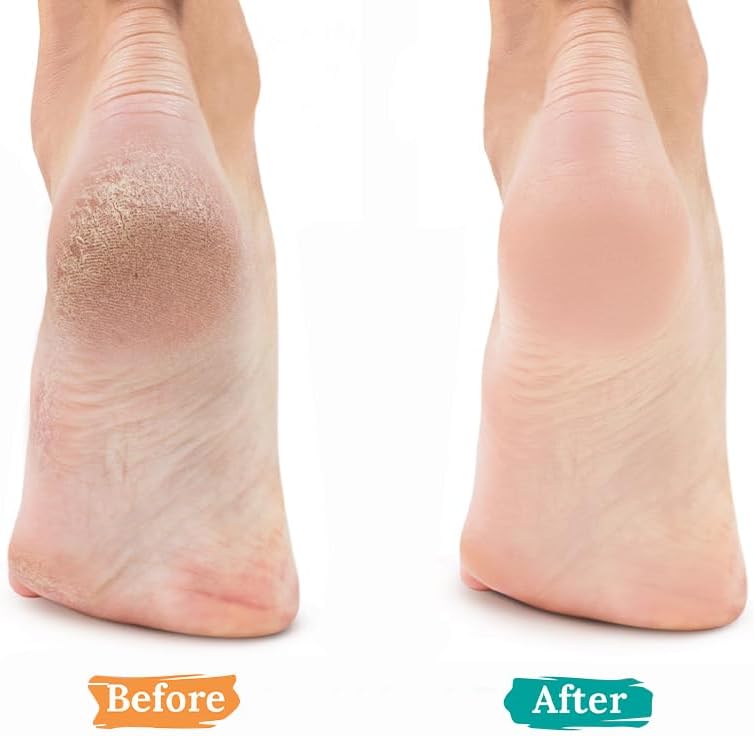 2 Pcs Natural Pumice Stone for Feet Lava Foot Pumice Stones Foot Exfoliation Pedicure Dead Skin Scrubber Heels Callus Remover