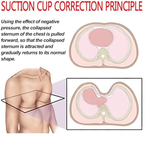 Pectus Excavatum Vacuum Bell, Pectus Excavatum Orthosis Brace,Pectus Excavatum Brace Physical Correction of Pectus Excavatum with Pressure Gauge(M)