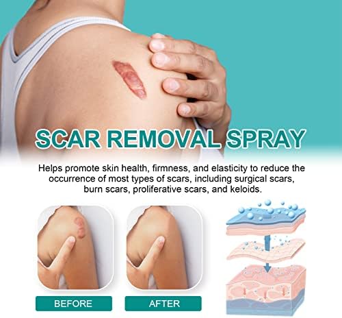 Scar Remove，Scar Remove Medical Grade Scar Spray，Etuih Scar Removal Spray，Acne Scar Treatment for Face, Acne Scars and Dark Spaot Remover, Gentle Skin Care for Acne Prone Skin (2PCS)