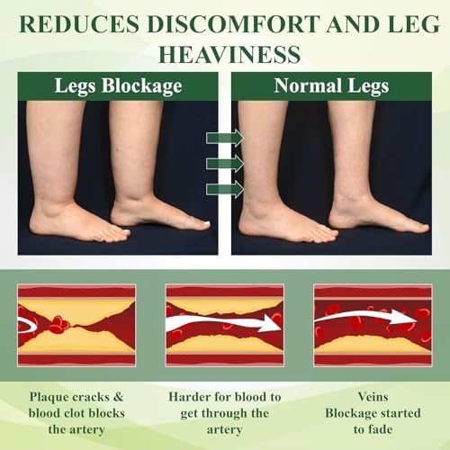 Fluidease Leg Therapy Edema Cream, Fluid Ease Leg Therapy Cream, Lymphatic Drainage Massage Cream, Care Lymphatic Massage Cream, Edema Relief for Legs and Feet (1)