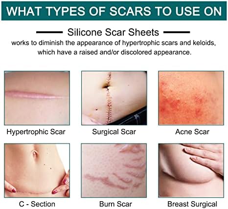 Silicone Scar Sheets (1.6” x 120” Roll-3M), Silicone Scar Tape Roll, Scar Silicone Strips, Reusable, Professional Scar Removal Sheets for C-Section, Surgery, Burn, Keloid, Acne et