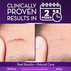 Cicatricure Advanced Scar Gel for Face & Body - Proven Results in 2 Weeks, Scar Treatment for Surgical Scars, Stretch Marks, Scars of Burns and Injuries, Acne Scar Treatment, 1 oz (28 g)