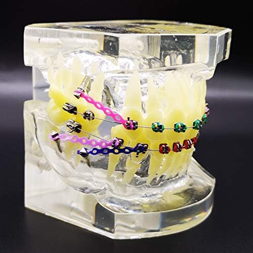 Dental Typodont with Metal Brackets Orthodontic Teeth Model with Ligature Tie