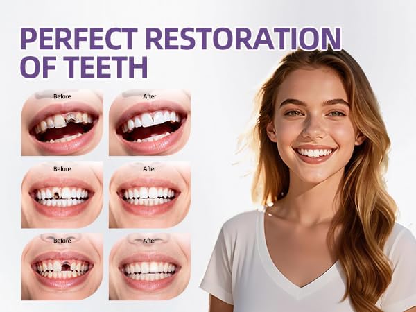 Tooth Repair Kit, Chipped or Missing Teeth, Temporary and Permanent Tooth Filling and Crown Fixing at Home
