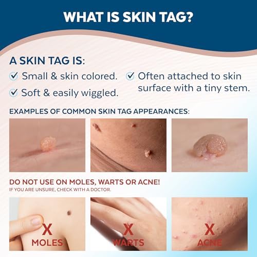 Claritag Advanced Skin Tag Remover - FDA-Cleared Device - Only for Skin Tag Removal - Works in 7-14 Days - Up to 10 Treatment Cycles - Cryogenic Freeze-Off Kit