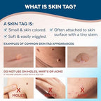 Claritag Advanced Skin Tag Remover - FDA-Cleared Device - Only for Skin Tag Removal - Works in 7-14 Days - Up to 10 Treatment Cycles - Cryogenic Freeze-Off Kit