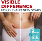 Medical Grade Silicone Scar Tape - 1.6”x150” - Visible Difference on Keloid & С-Section - Reusable Silicone Scar Sheets - Easy to Use