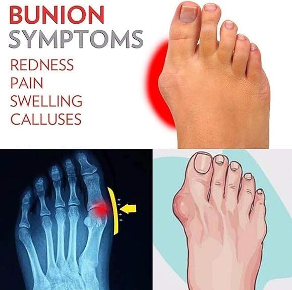 CLSQLXYJZC Mens Bunion Sandals, Summer Breathable Men's Non- Slip Slip-On Bunion Relief Sandals, Orthopedic Open Toe Utdoor Beach Holiday Flip Flops, for Papa, Husband, Big Toe Bone Orthopedic