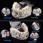 Ultrassist Transparent Dental Disease Teeth Model with Removable Teeth, Dental Pathology Demonstration Model for Dentist Patient Education & Teaching