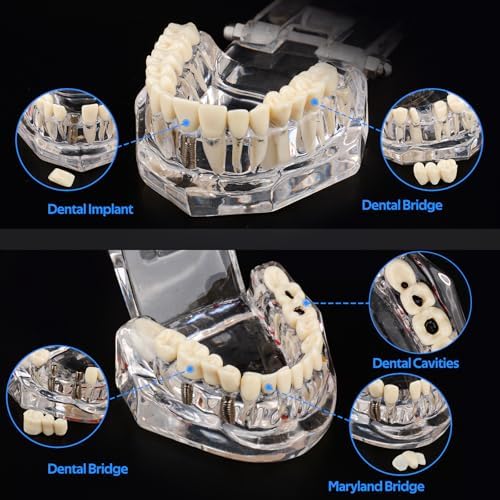 Ultrassist Transparent Dental Disease Teeth Model with Removable Teeth, Dental Pathology Demonstration Model for Dentist Patient Education & Teaching