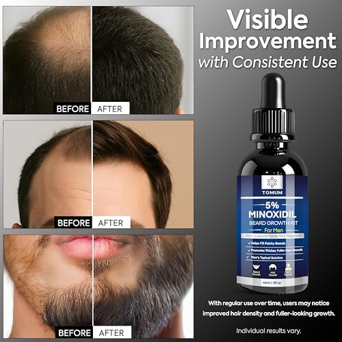 TOMUM 5% Minoxidil Beard Growth Kit for Men – Hair & Beard Regrowth Serum, Helps Fill Patchy Beards, Thicker Fuller Facial & Scalp Hair, Topical Solution