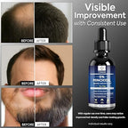 TOMUM 5% Minoxidil Beard Growth Kit for Men – Hair & Beard Regrowth Serum, Helps Fill Patchy Beards, Thicker Fuller Facial & Scalp Hair, Topical Solution