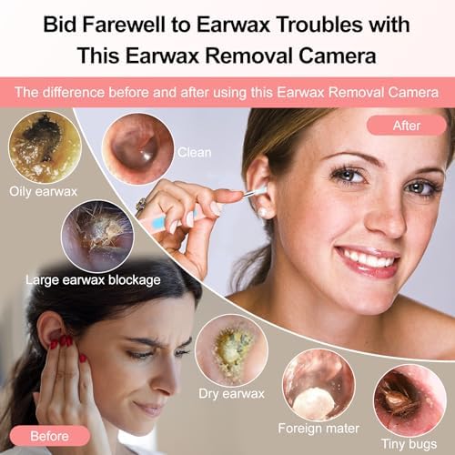 Ear Wax Removal, Ear Cleaner with 1080P HD Camera, with 6 LED Lights/IP67 Waterproof Lens/8 Traditional Tools Ear Wax Removal Kit, Rechargeable Ear Cleaning kit for iOS/Android/Tablet, Pink