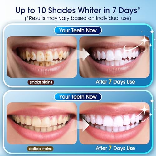 Teeth Whitening Kit with LED Light – 3 Whitening Gel Pens + 2 Desensitizing Pens – 35% Carbamide Peroxide – Whiten Teeth in 7 Days – Safe for Sensitive Teeth & Enamel, 0.7 Fl Oz (Mint)