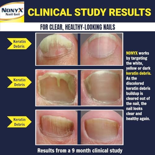 NONYX Fungal Nail Clarifying Gel | Clinically Proven for Discolored, Thick, Brittle, Yellow, Lifted, and other signs of Fungus-Damaged Toenails | 90% of Nails Improve | Over 8 million sold