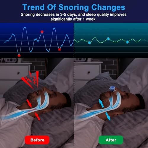 Anti Snoring Device - Mini SleepApnea Devices - Variable Anti Snoring Aid - Upgraded StopSnoring Solution - Suitable for All Nose Shapes - Blue