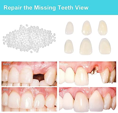 Brige Tooth Repair kit for Filling The Missing Broken Tooth and Gaps-Moldable Fake Teeth and Thermal Beads Replacement Kit for Women and Men