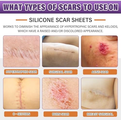 Silicone Scar Sheets,Silicone Scar Tape,Silicone Scar Removal Strips for Surgical,C-Section,Tummy Tuck,Keloid Scars (1.6"X 157" Roll-4M) Keloid Bump Removal