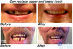 Instant Smile MULTISHADE Patented Temporary Tooth Repair Kit. A Realistic Looking Fix for a Missing or Broken Tooth.