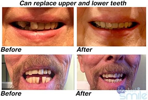 Instant Smile MULTISHADE Patented Temporary Tooth Repair Kit. A Realistic Looking Fix for a Missing or Broken Tooth.
