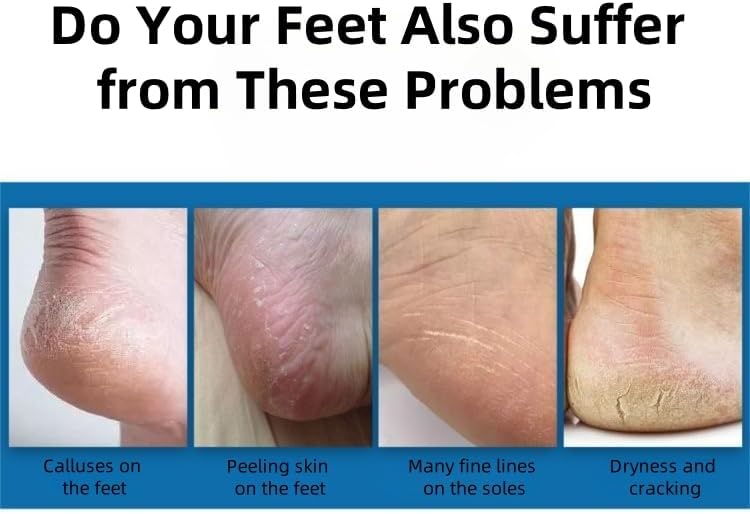 Foot Pumice Stone, 2 Pack Pedicure Stone for Feet Pumice Sponge for Feet Callus Remover and Scrubber