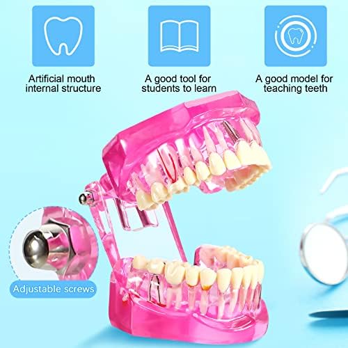 Outus Disease Teeth Model Dental Implant Teeth Model with Removable Tooth Dentist Standard Tooth Pathological Demonstration for Christmas Education Dental Supplies(Pink,1 Pcs)