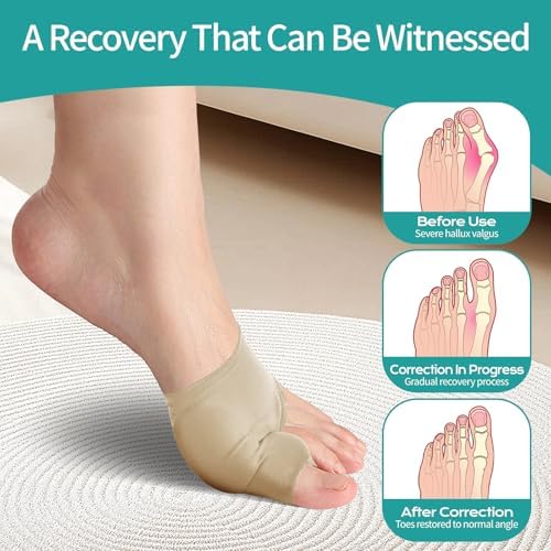 Bunion Corrector for Hallux Valgus - Big Toe Straightener & Bunion Splint for Overlapping Big Toes, Instant Bunion Relief & Pain Relief, Comfortable Breathable Fabric for All-Day Wear(Khaki 2-Pack) (Large)