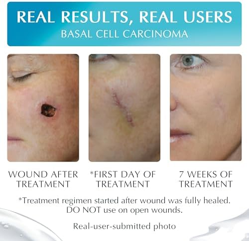 Advanced High-Potency Silicone Scar Gel with Vitamin E for Old, New Scars, Surgery, Keloids, Burns, and Facial Blemish Scars, NewGel Plus by MyNewGel (15 Grams) - 0.50 oz